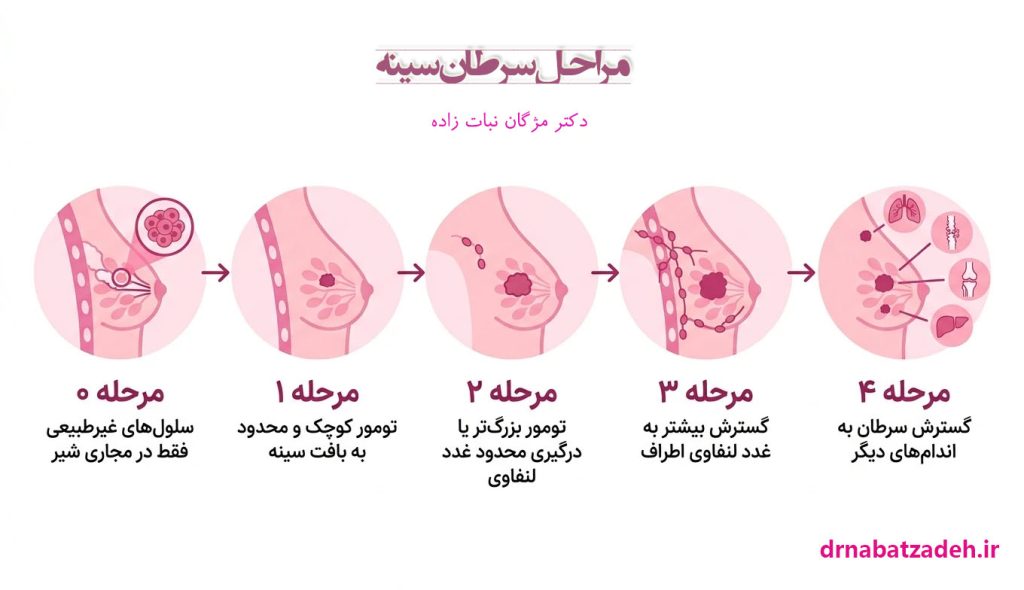 مراحل سرطان پستان